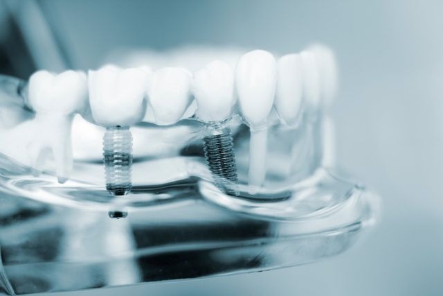 Dental implants model