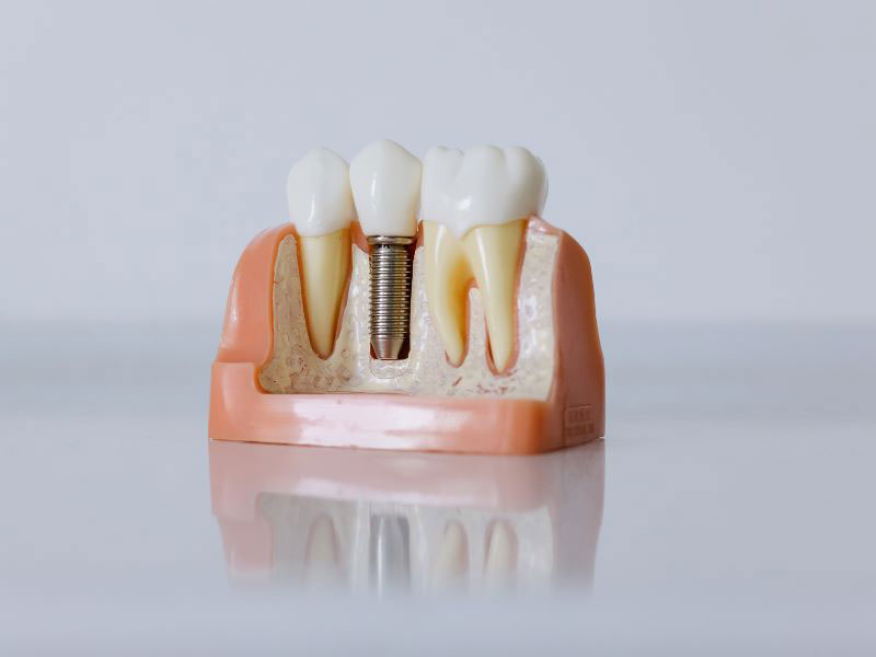 Dental Implants