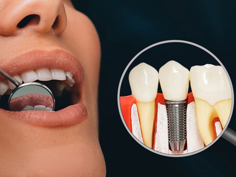 Dental Implants Phoenix